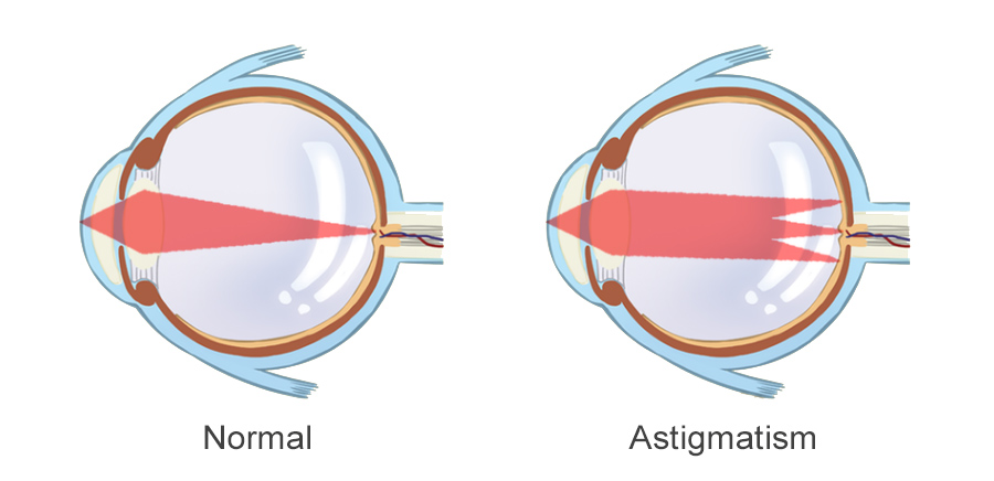 Astigmatism-1